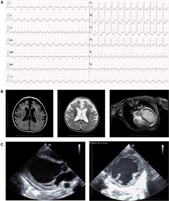 Case Report: Lethal mitochondrial cardiomyopathy linked to a compound heterozygous variant of PARS2